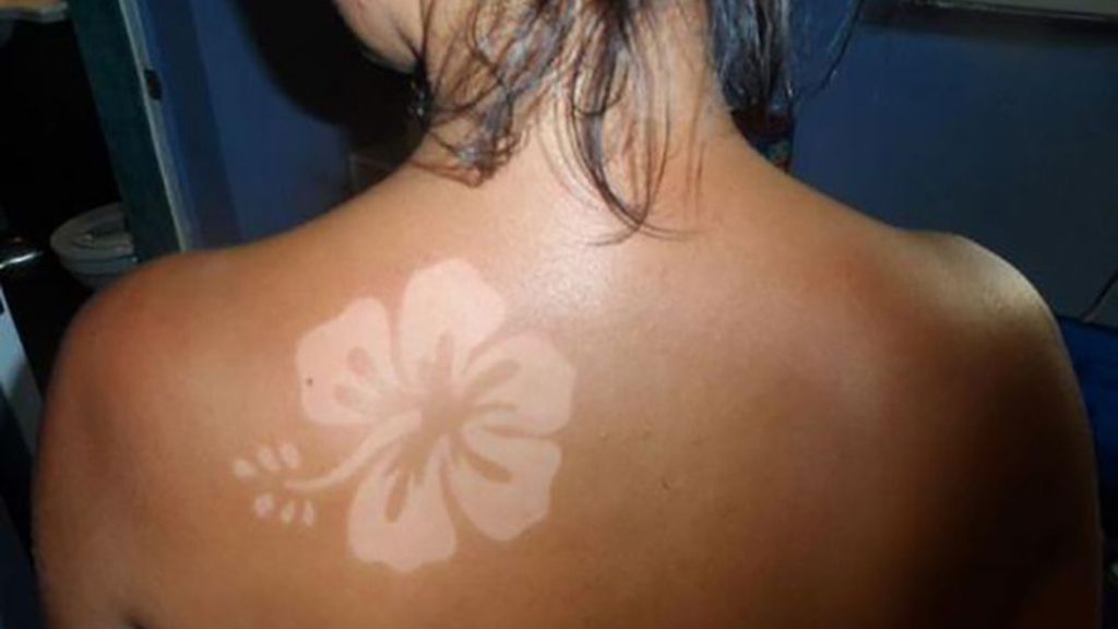 Sunburn Art, el arte de quemarse al sol