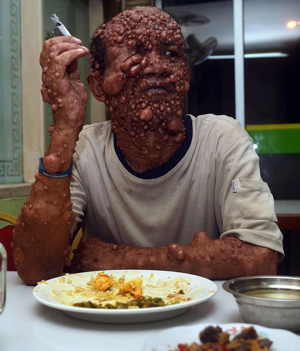 Devastado por tumores benignos