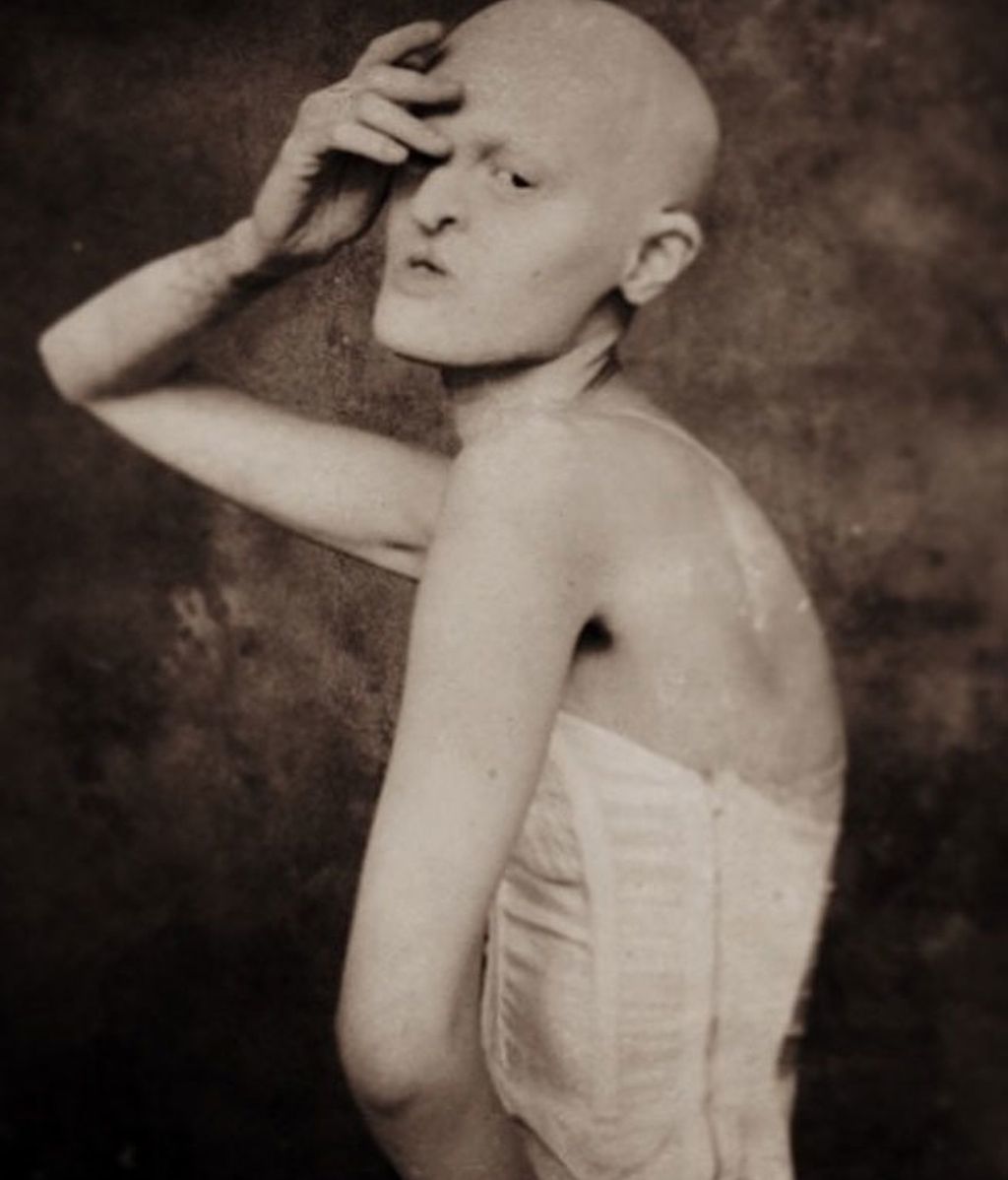 Melanie Gaydos, del complejo por su Displasia Ectodérmica a la pasarela