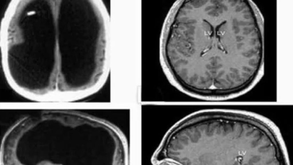 Sin cerebro Sin cerebro