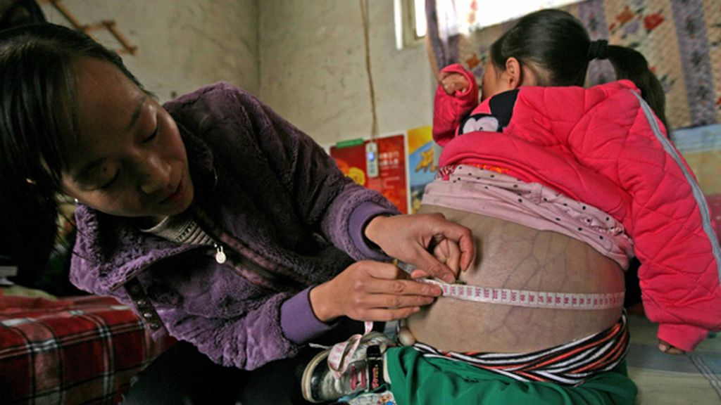 Padece una enfermedad que hincha su abdomen hasta límites extremos