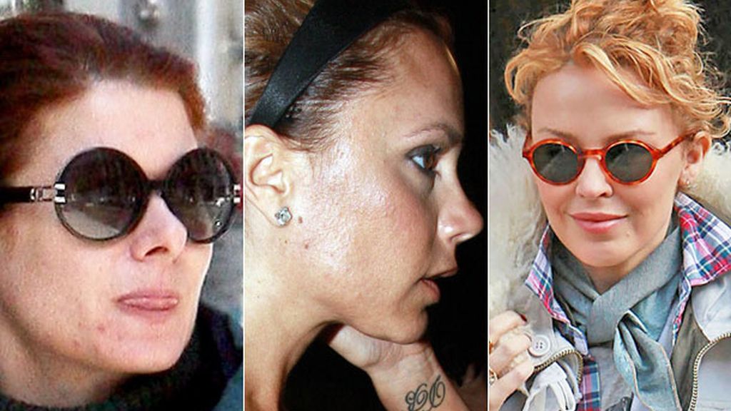 Los famosos también sufren con el acné