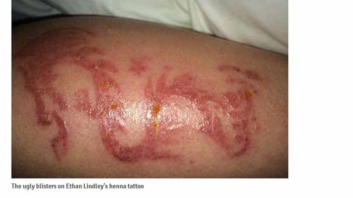Un tatuaje con henna le deja marcada de por vida la pierna a un niño de 12 años