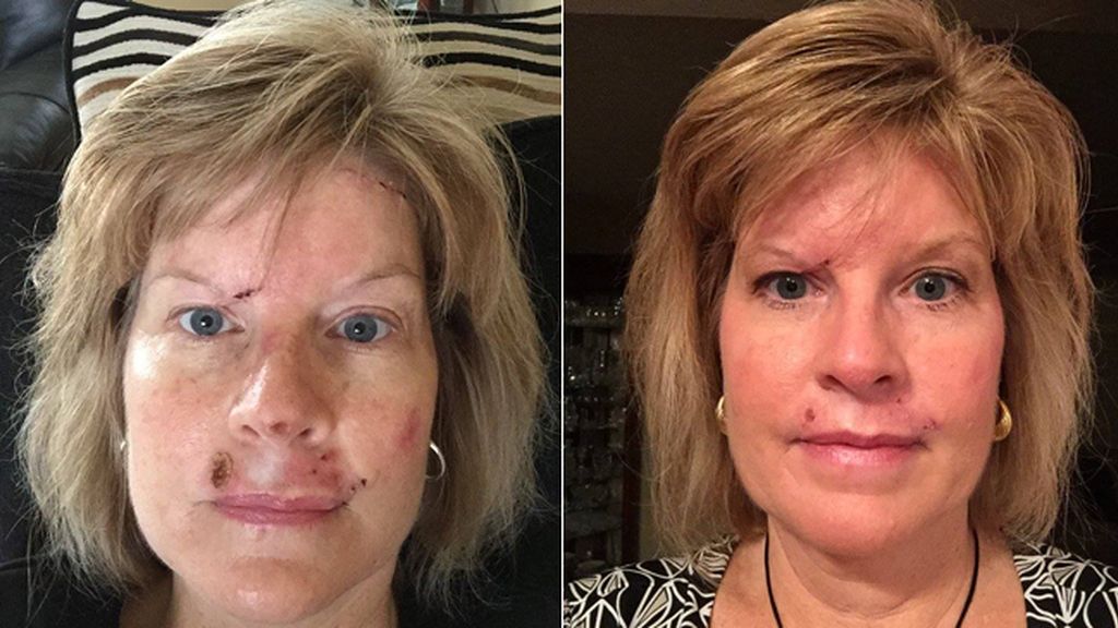 La lucha contra el cáncer de piel en imágenes