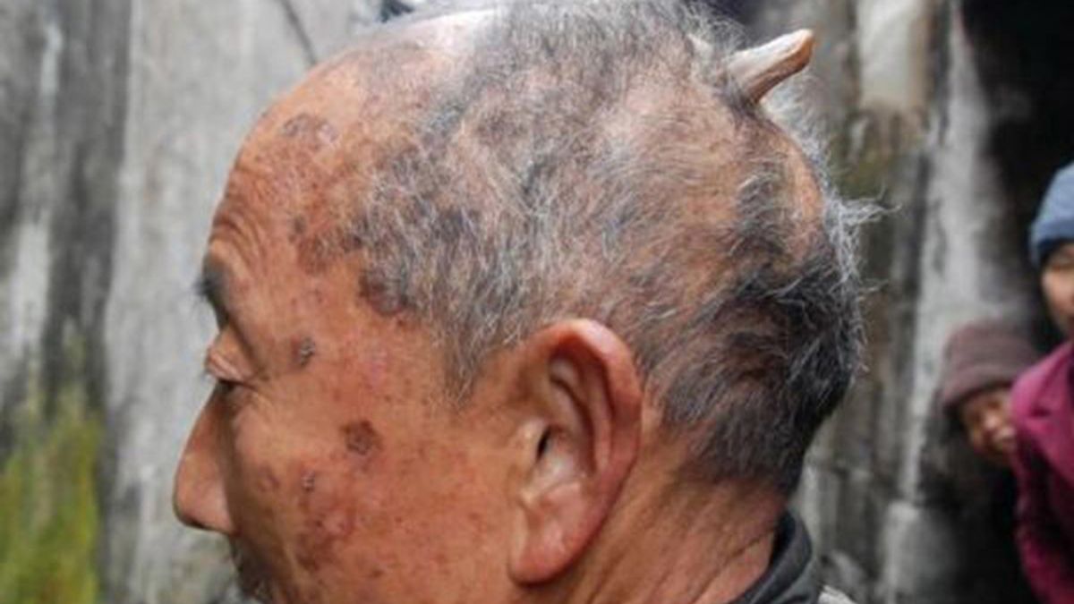 Un cuerno en la parte trasera de la cabeza le ha crecido a este hombre chino de 84 años. Foto: Iberpress