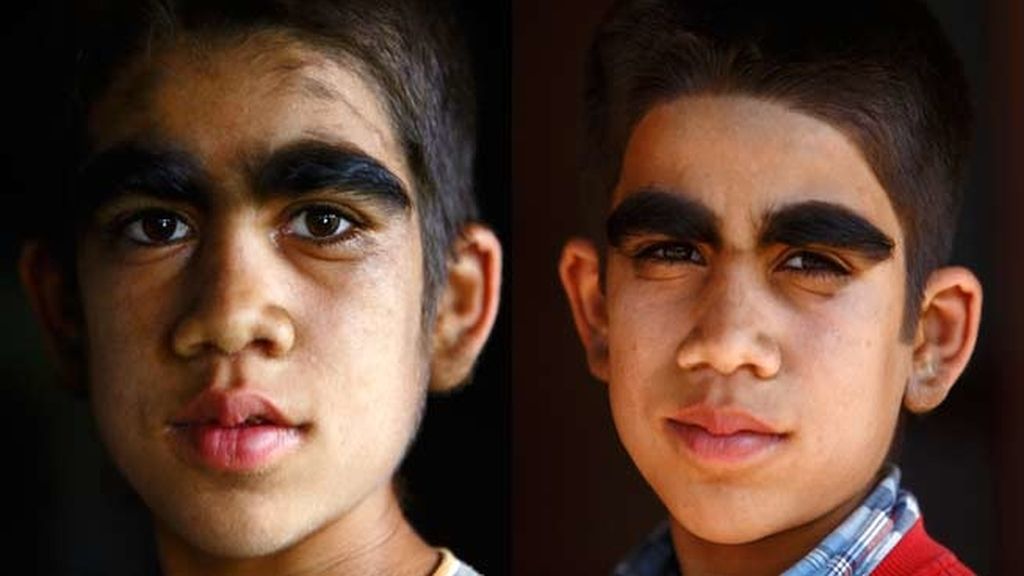 La hipertricosis les cubre todo el cuerpo de vello