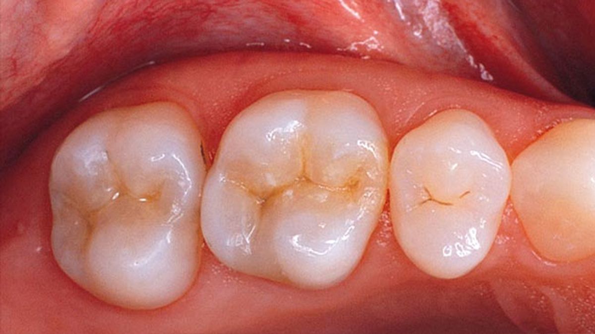 caries,salud dental, dientes,