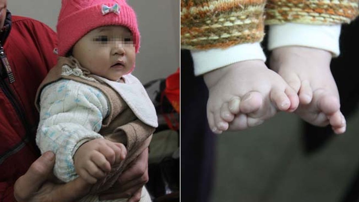 Un bebé nace con 26 dedos