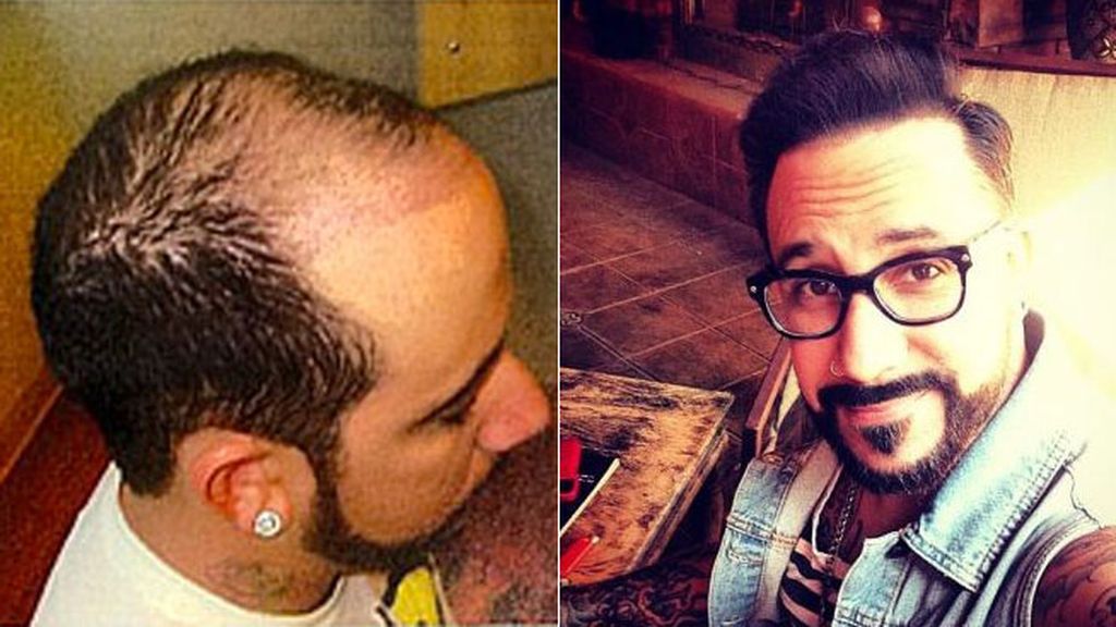 El trasplante de pelo llegó