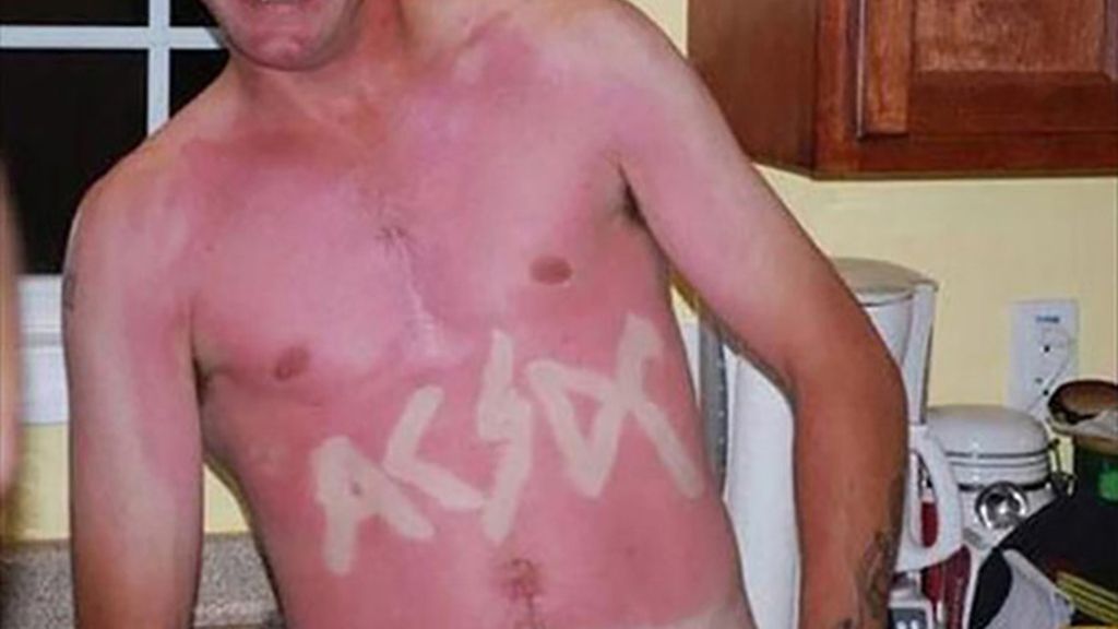 Sunburn Art, el arte de quemarse al sol
