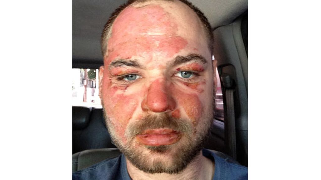 mago houchin quemaduras