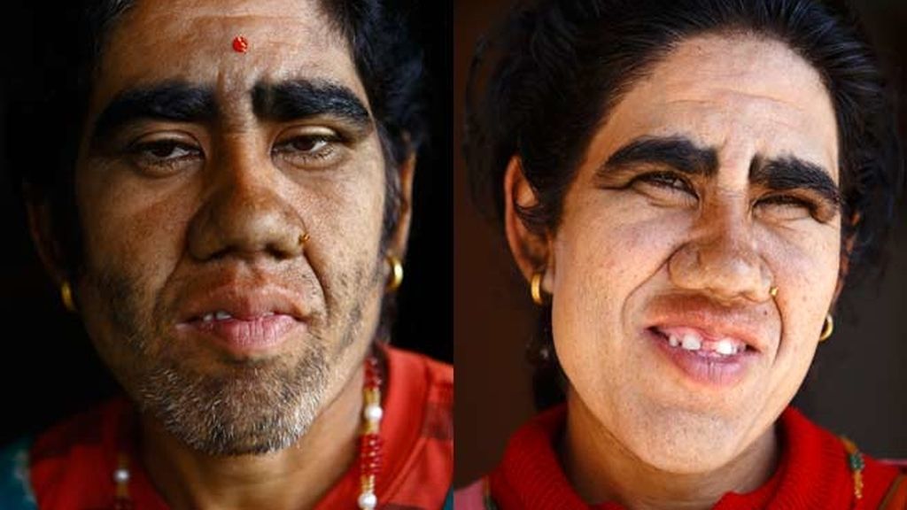 La hipertricosis les cubre todo el cuerpo de vello