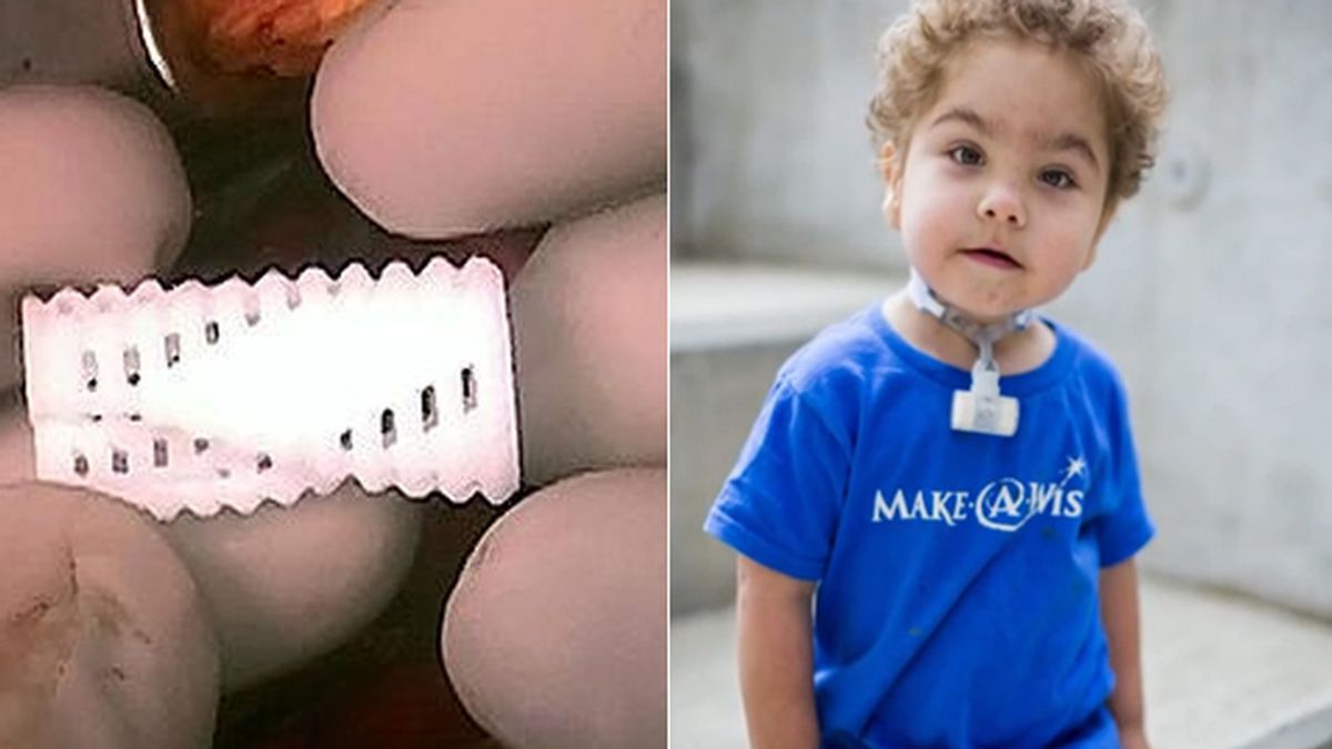 Una férula en 3D salva la vida a tres recién nacidos Una férula en 3D salva la vida a tres recién nacidos