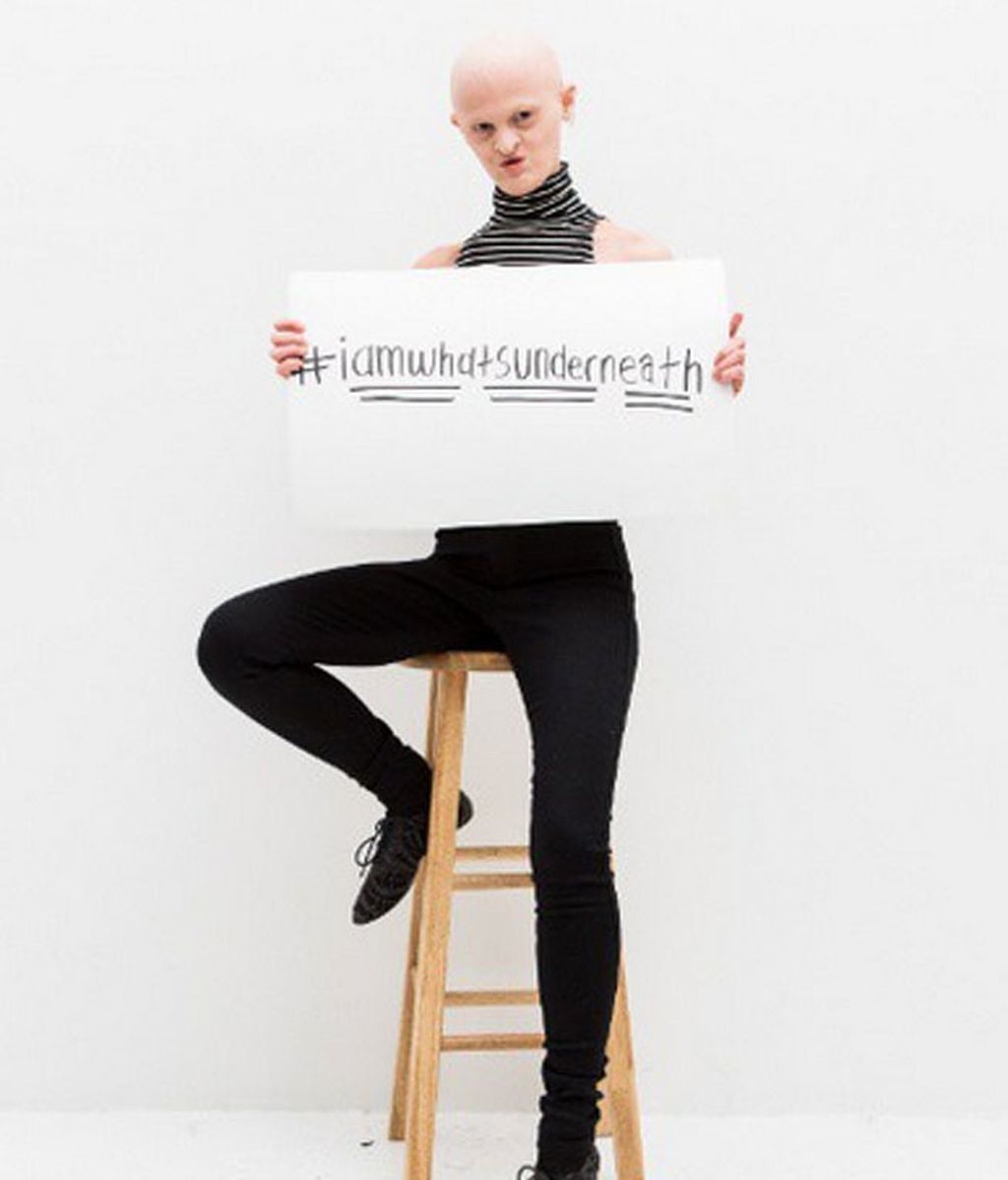 Melanie Gaydos, del complejo por su Displasia Ectodérmica a la pasarela