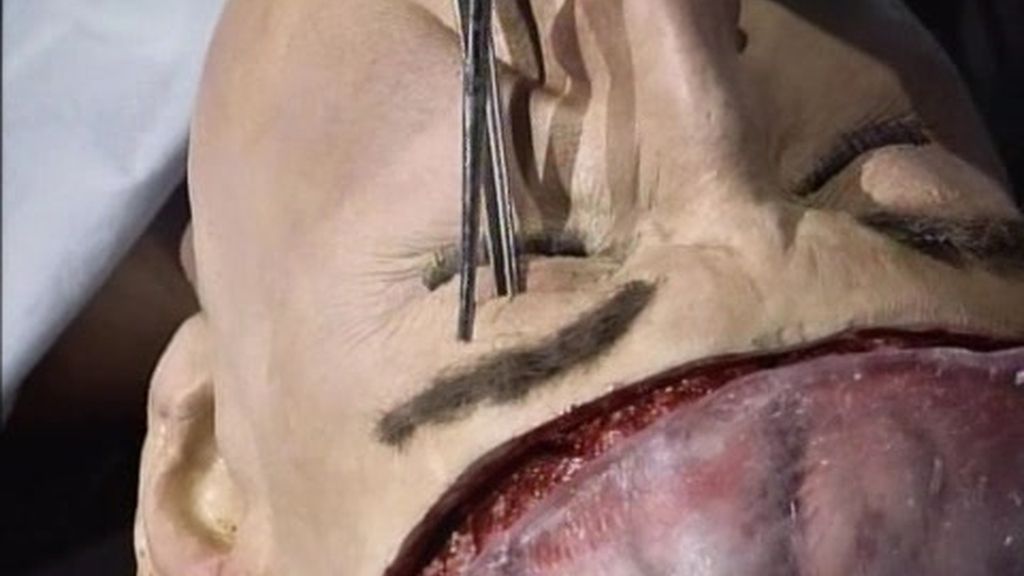 Lobotomía: ladrones de alma