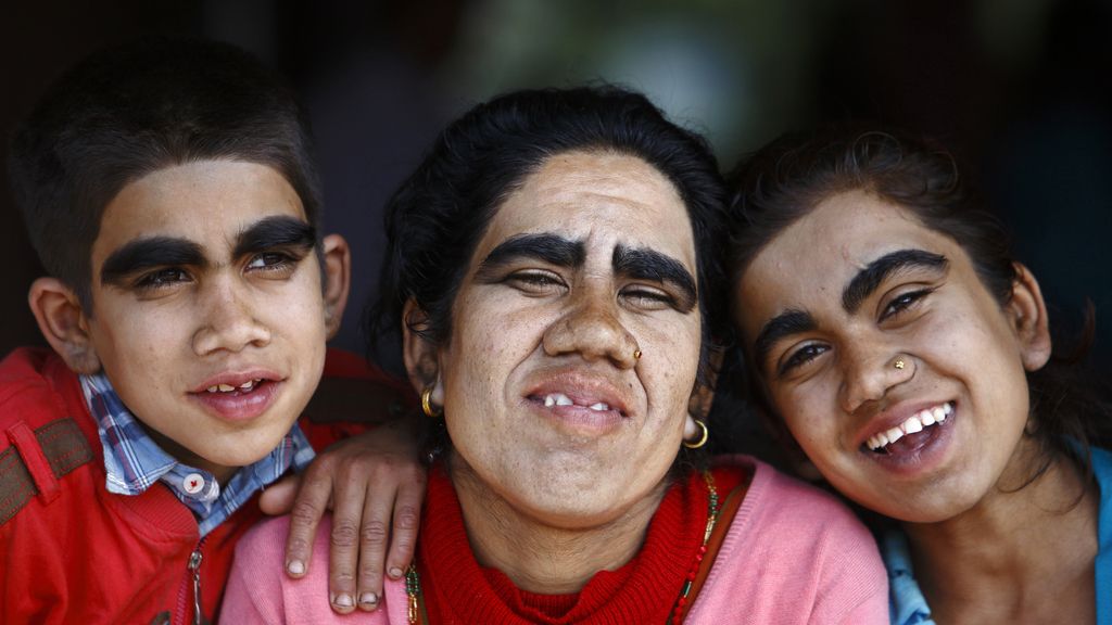 La hipertricosis les cubre todo el cuerpo de vello