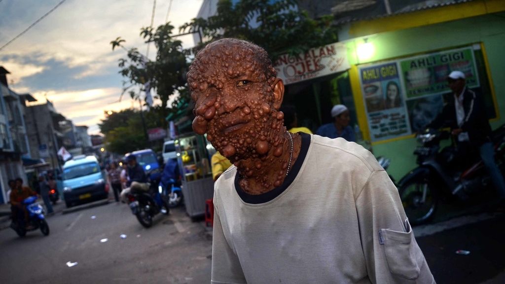 Devastado por tumores benignos