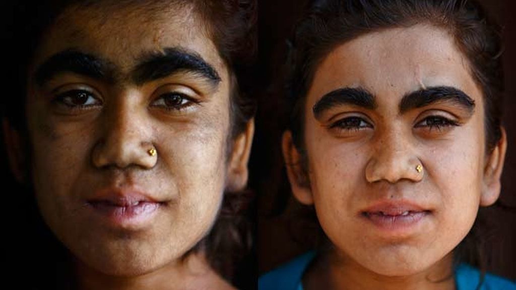 La hipertricosis les cubre todo el cuerpo de vello