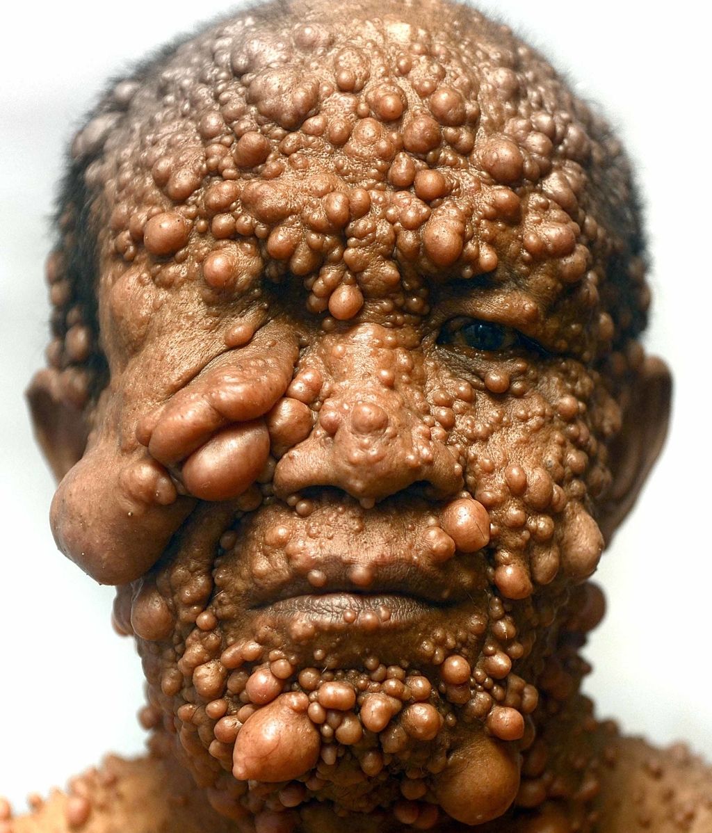 Devastado por tumores benignos