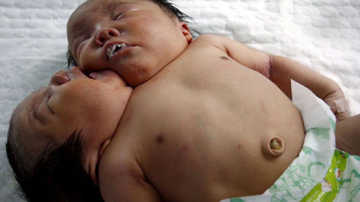 Nace un bebé con dos cabezas en China