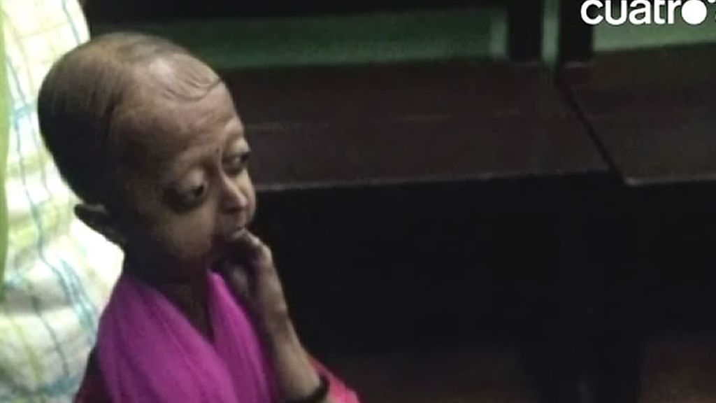 Tiene 19 años y es la única chica afectada de progeria de su familia