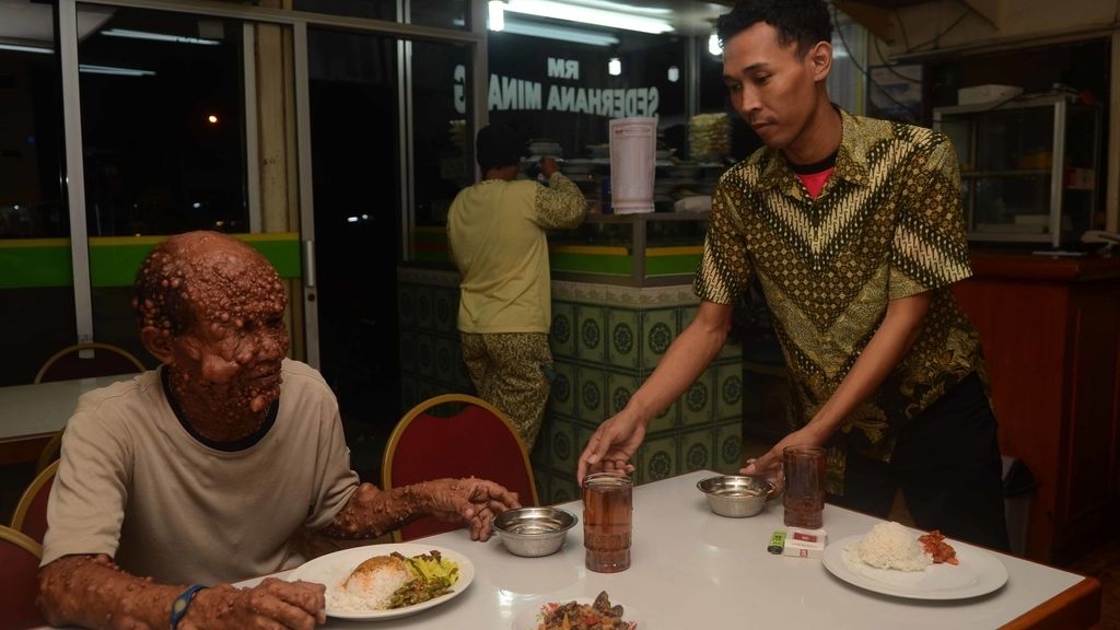 Devastado por tumores benignos