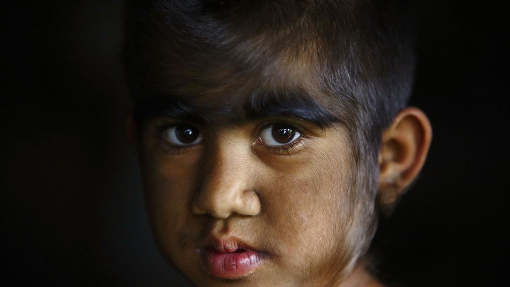 La hipertricosis les cubre todo el cuerpo de vello