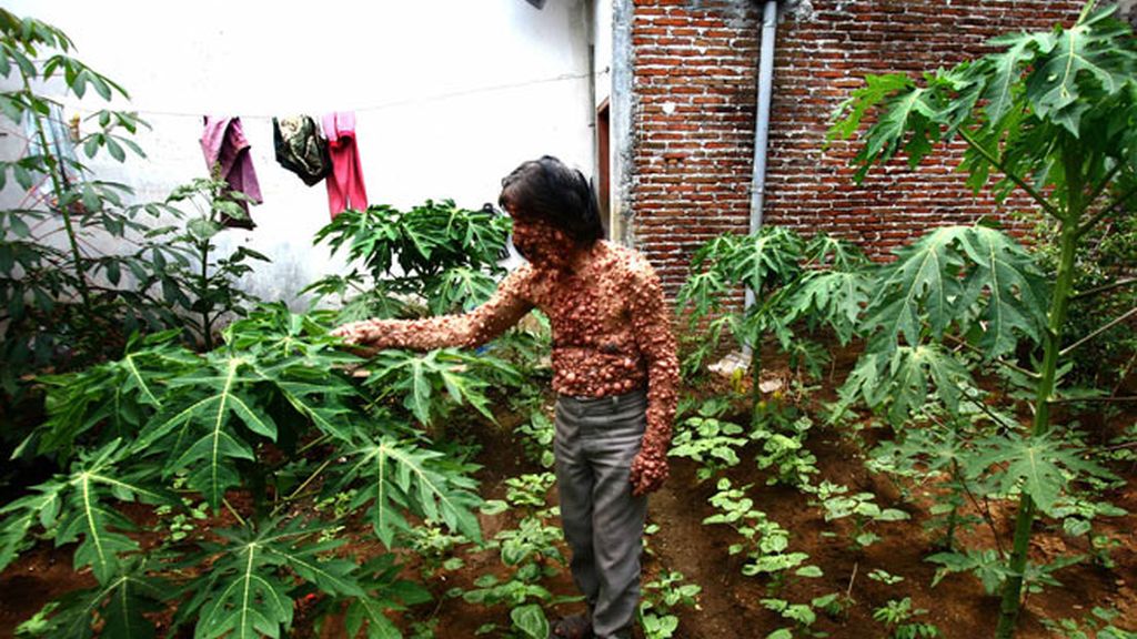 Vivir con el cuerpo cubierto de tumores