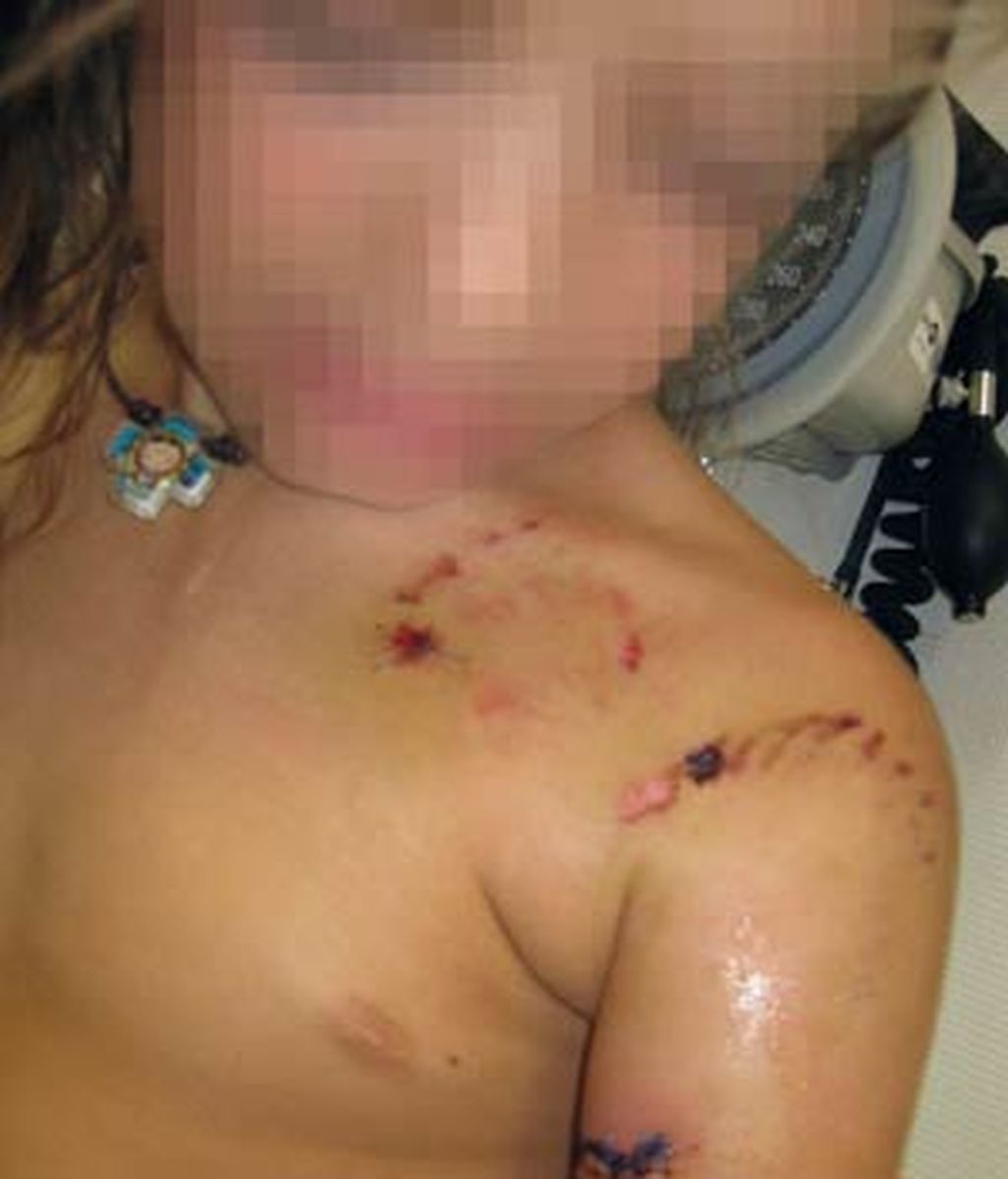 La pequeña sufrió heridas incisas en la región pectoral y en brazo y hombro izquierdos. Foto: EFE La pequeña sufrió heridas incisas en la región pectoral y en brazo y hombro izquierdos. Foto: EFE