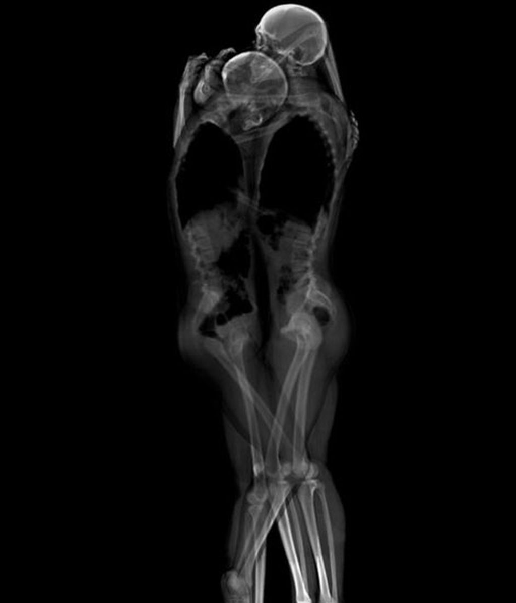 El amor visto con los rayos X