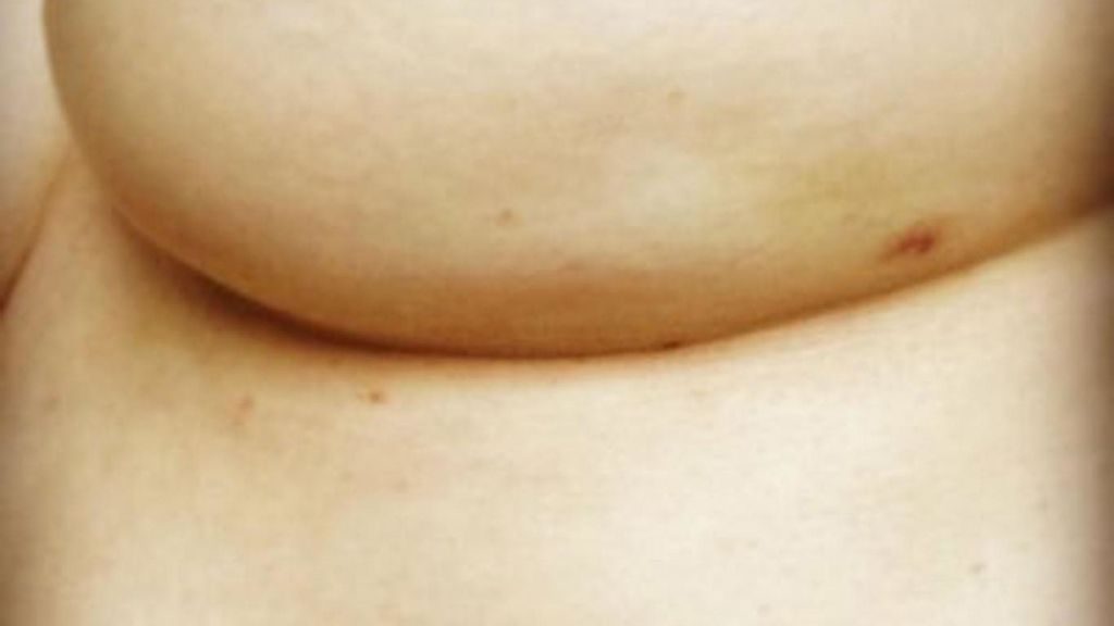 Foto viral que muestra uno de los síntomas del cáncer de mama Foto viral que muestra uno de los síntomas del cáncer de mama