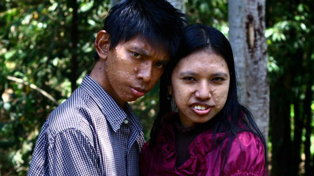 Vivir con el cuerpo cubierto de tumores