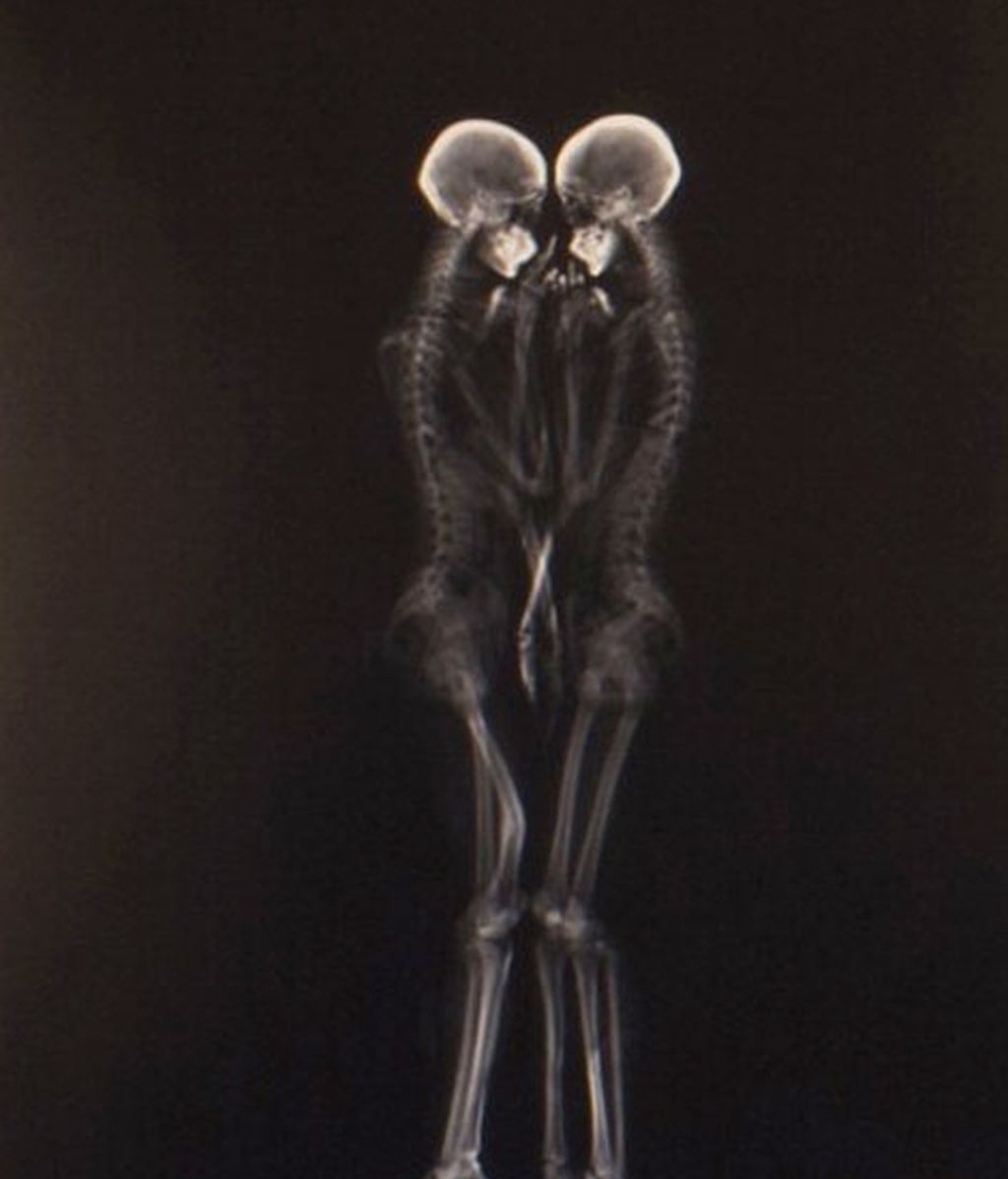 El amor visto con los rayos X