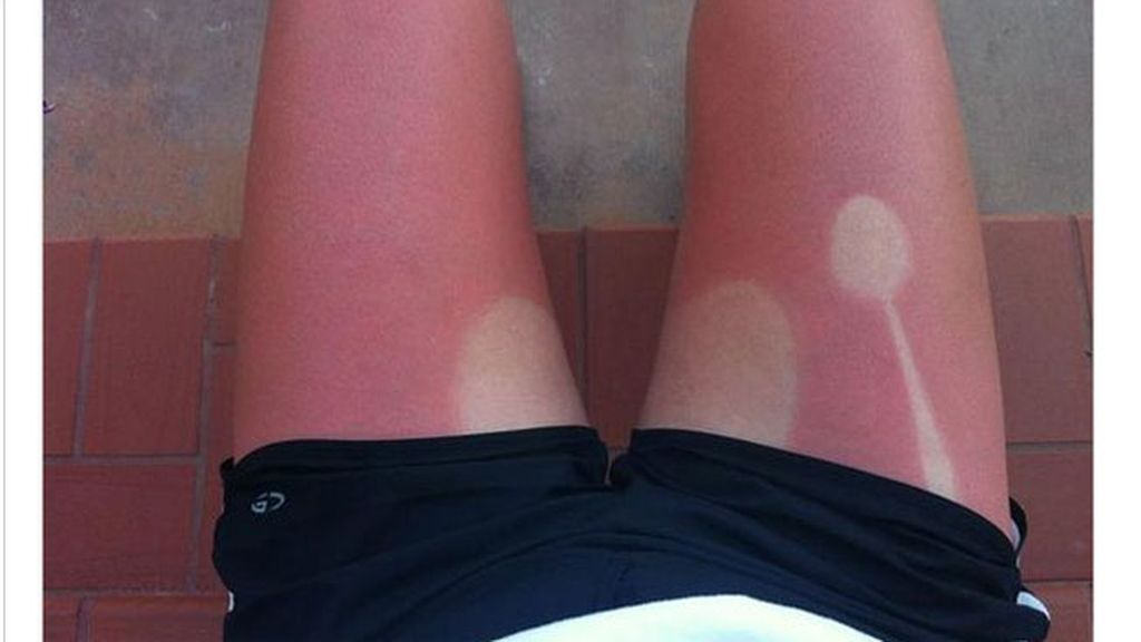 Cuando el sol te marca