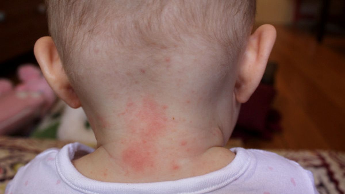 alergia al níquel,iPad,alergia al iPad,pediatras advertencia