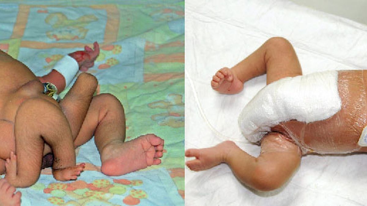 Operan con éxito a un bebé en Pakistán que nació con seis piernas