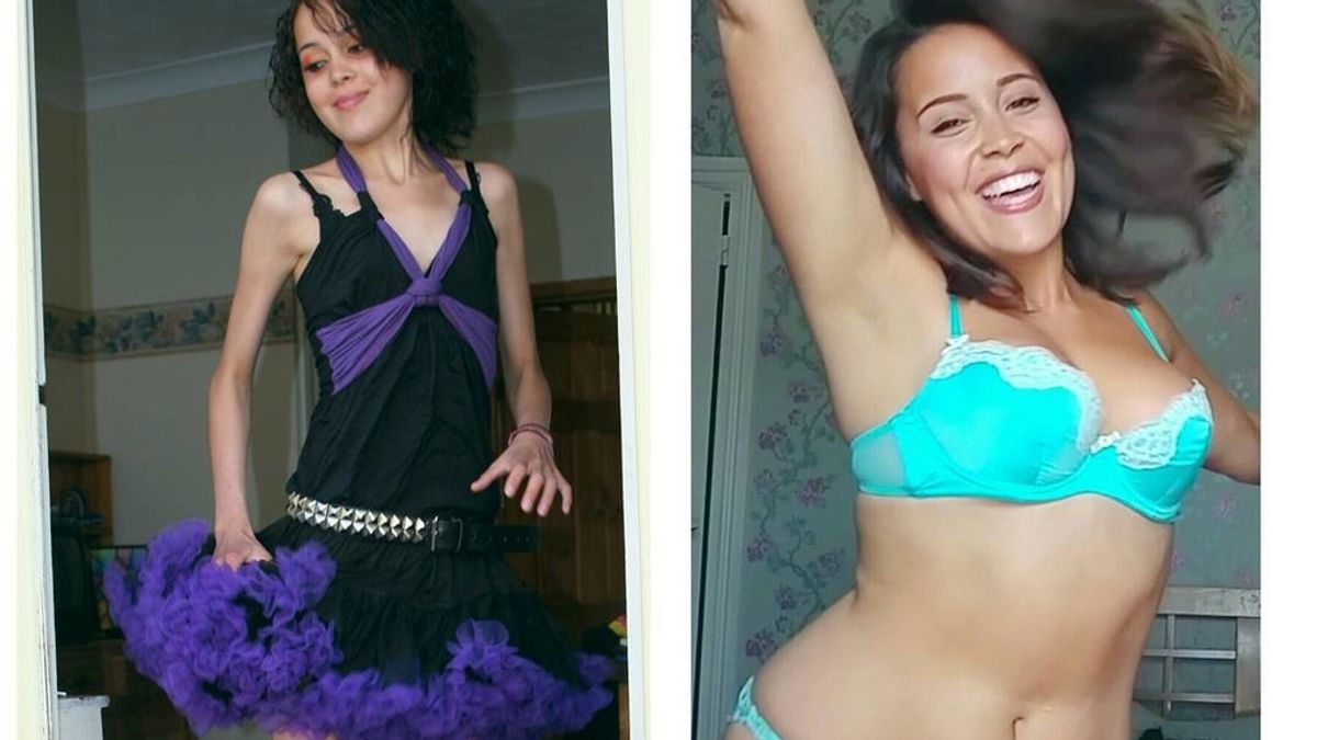 Megan Jayne antes y depués de anorexia