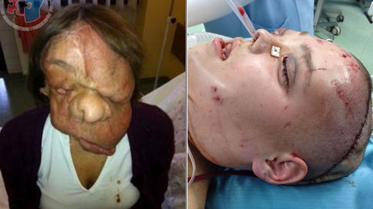 Le hacen un trasplante total de cara porque un tumor le había deformado