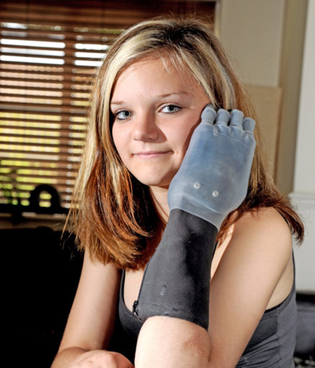 Feliz con sus nuevos dedos