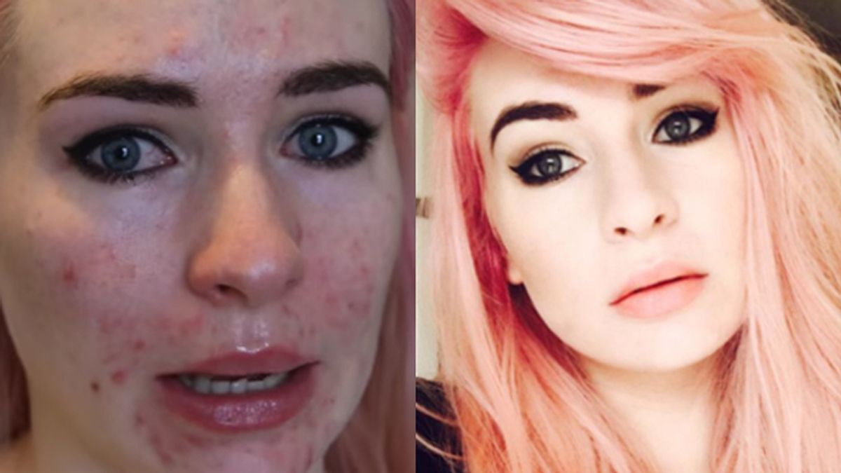 La Red se rinde a una bloguera de moda tras documentar su íntima lucha contra el acné