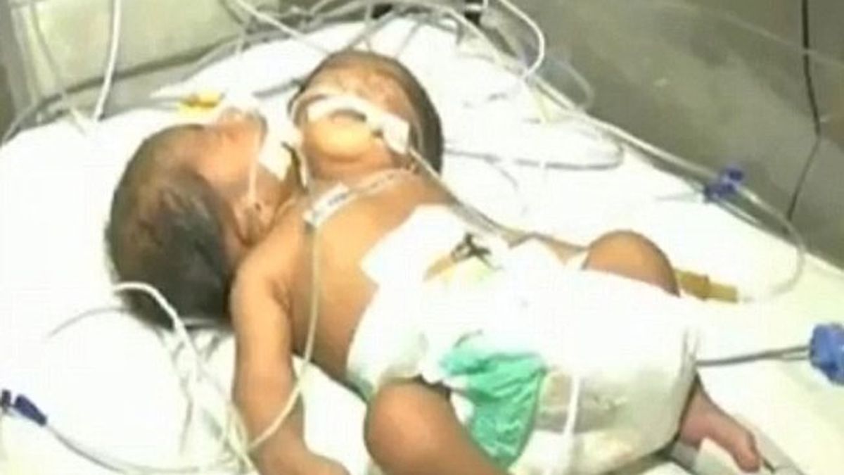 Nacen dos gemelos unidos por el pecho en India