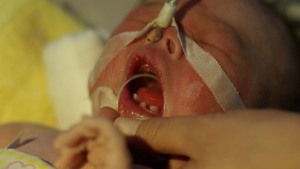 Sorpresa: Mi bebé nació con dientes