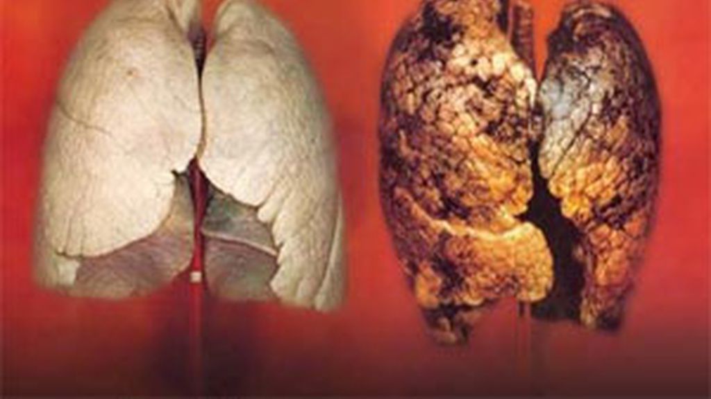 El cáncer de pulmón es uno de los más frecuentes en nuestro país. En la imagen puede observarse la diferencia entre un pulmón sano y un pulmón afectado por el humo de los cigarrillos. El cáncer de pulmón es uno de los más frecuentes en nuestro país. En la imagen puede observarse la diferencia entre un pulmón sano y un pulmón afectado por el humo de los cigarrillos.