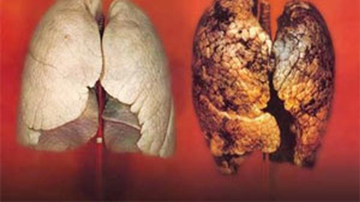 El cáncer de pulmón es uno de los más frecuentes en nuestro país. En la imagen puede observarse la diferencia entre un pulmón sano y un pulmón afectado por el humo de los cigarrillos.