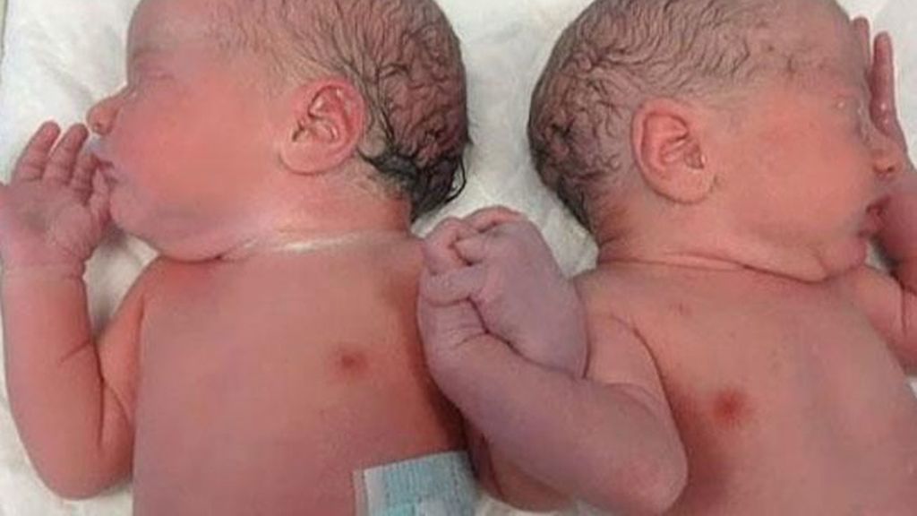 Mellizos unidos por las manos