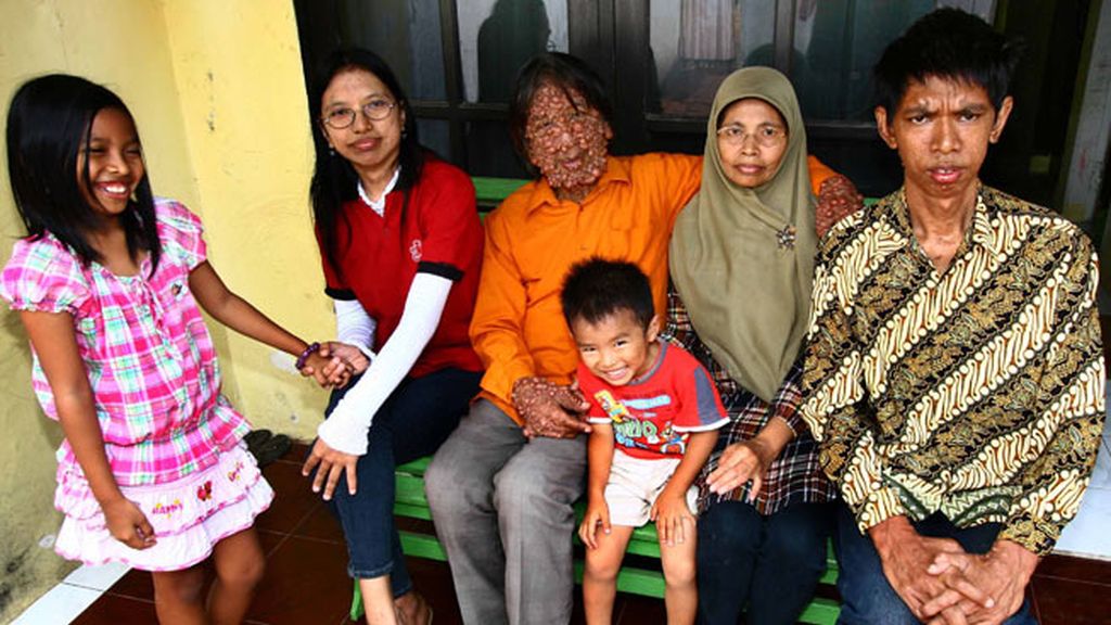 Vivir con el cuerpo cubierto de tumores