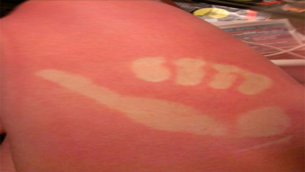 Cuando el sol te marca