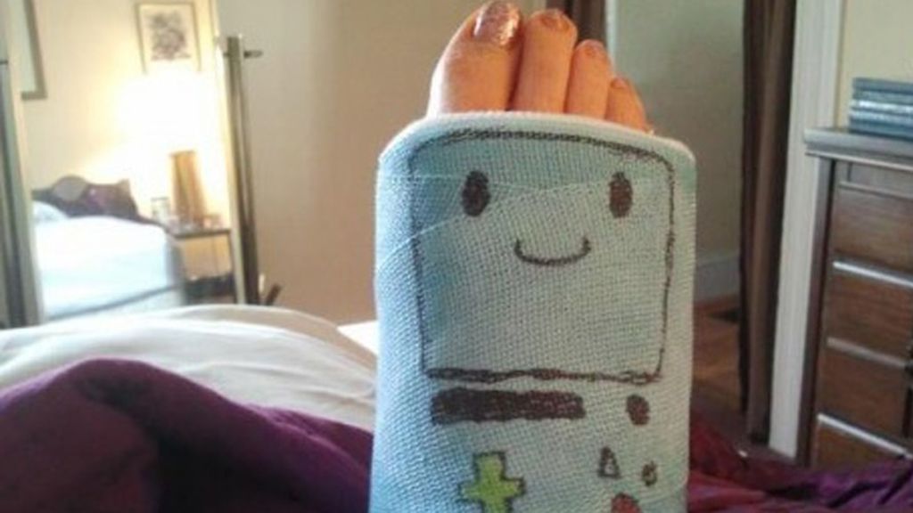 Si te rompes una pierna... ¡sonríe!