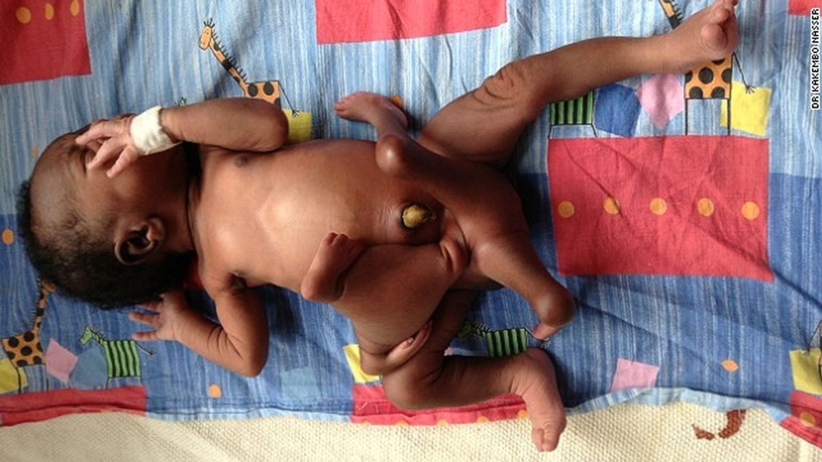 bebé con ocho extremidades,Uganda,Paul Mukisa,Mulago Hospital en Kampala,gemelo parasitario