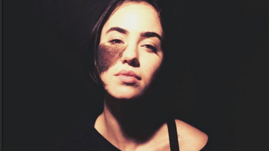 Nació con un lunar en su cara que la hace especial